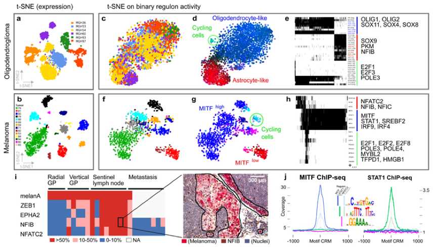  Use single-cell RNA-seq data to carry out relevant cell states and gene regulatory networks (GRNs) in cancer. 