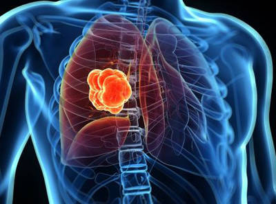 Lung Cancer Panel Sequencing