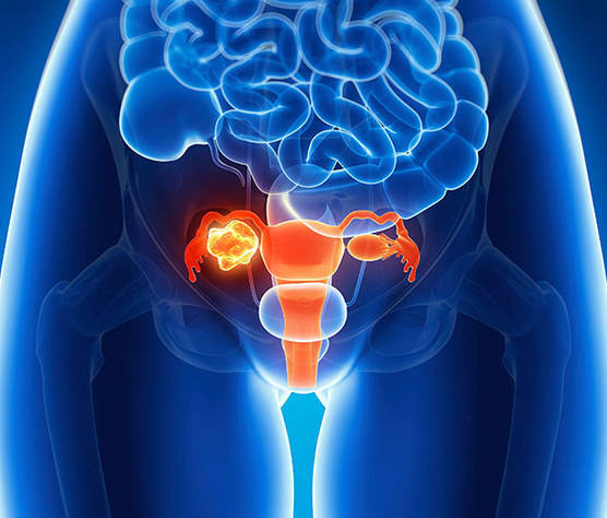Custom Ovarian Cancer Panel