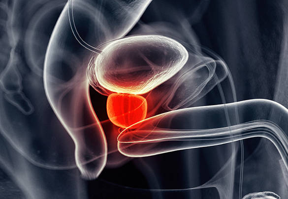 Custom Prostate Cancer Panel