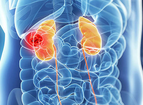 Custom Renal Cancer Panel