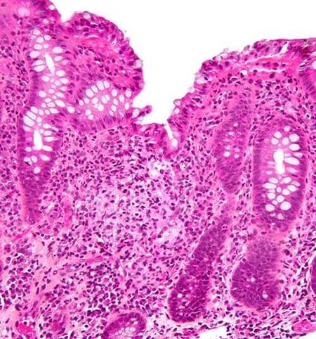 Custom Chronic Granulomatous Disease Panel