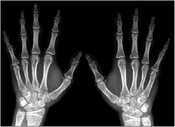 Custom Multiple Epiphyseal Dysplasia Panel