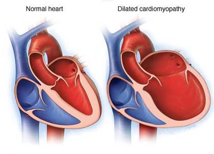 Custom Dilated Cardiomyopathy Panel