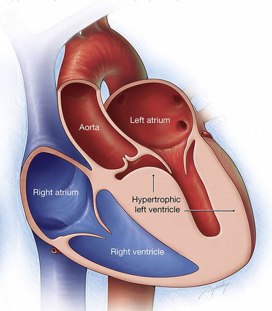 Custom Hypertrophic Cardiomyopathy Panel