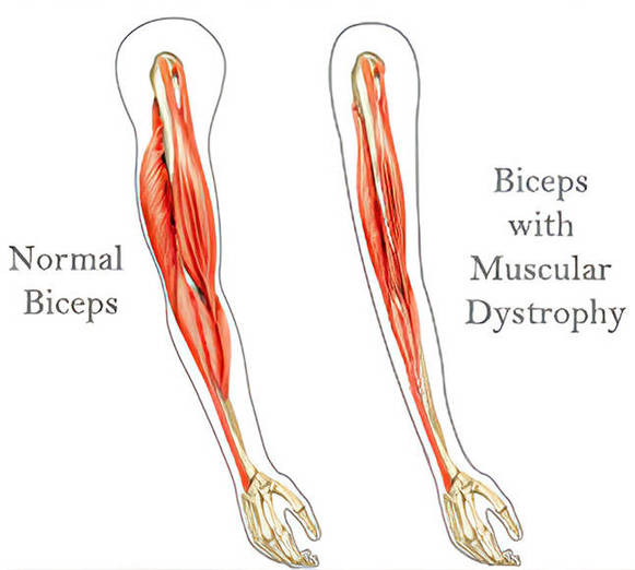 Custom Muscular Dystrophy Panel