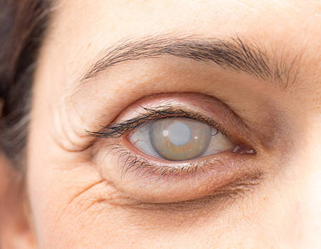 Custom Cataract Panel