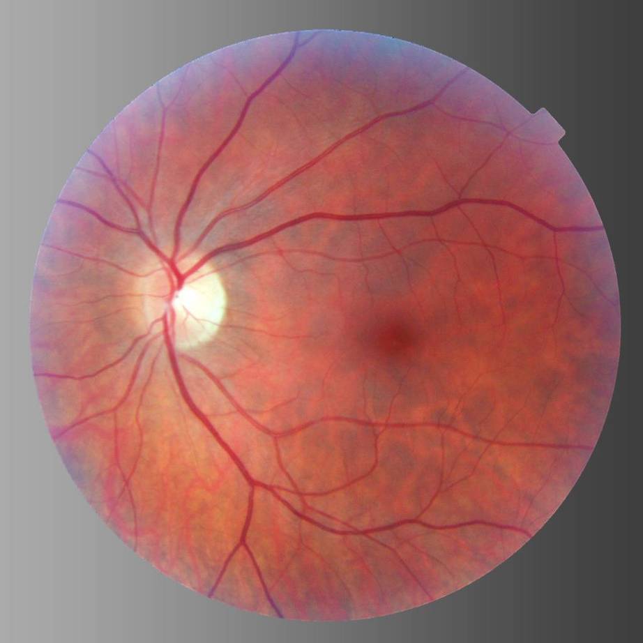 Custom Vitreoretinopathy Panel