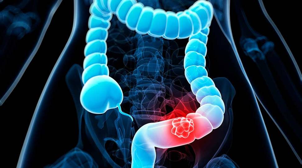 Colorectal Cancer Panel Sequencing