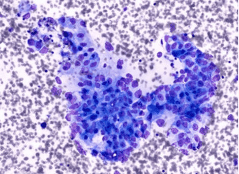 Solid Tumor Panel Sequencing (500 genes)
