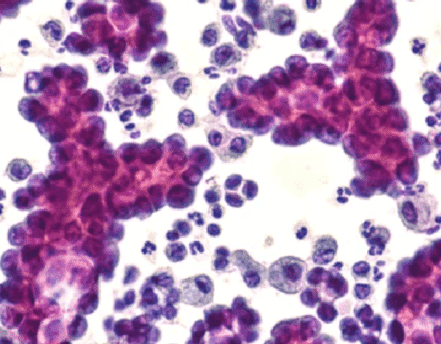Solid Tumor Whole Exome Sequencing