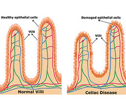 Custom Celiac Disease Panel