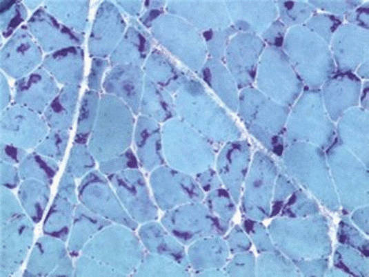 Custom Congenital Myopathy/Myotonia Panel