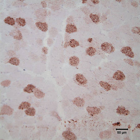 Custom Metabolic Myopathies Panel