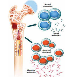 Custom Myeloma Panel