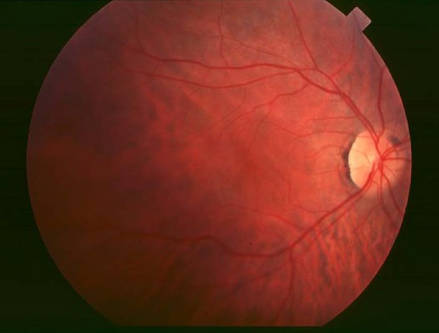 Custom Retinitis Pigmentosa Panel