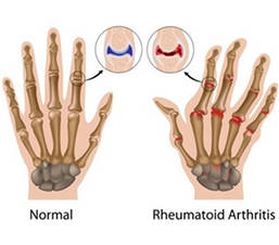 Custom Rheumatoid Arthritis Panel