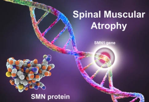 Custom Spinal Muscular Atrophy Panel