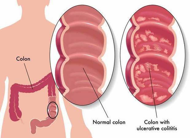 Custom Ulcerative Colitis Panel