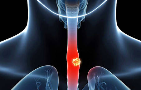 Esophageal Cancer Panel Sequencing