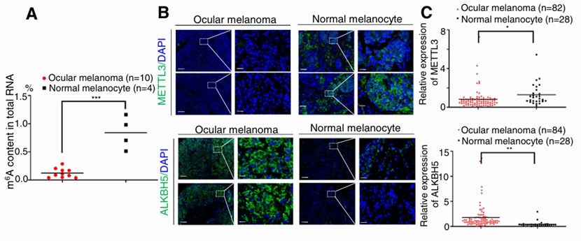 Ocular melanoma exhibited decreased m6A levels (Jia et al., 2019)