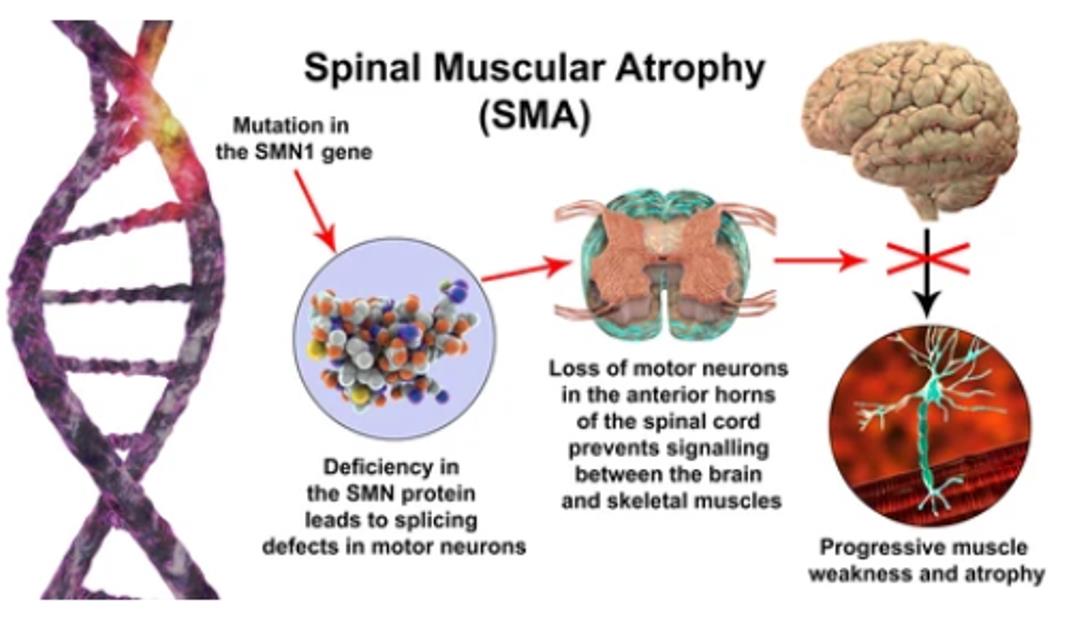 PacBio HiFi Sequencing for Spinal Muscular Atrophy Analysis