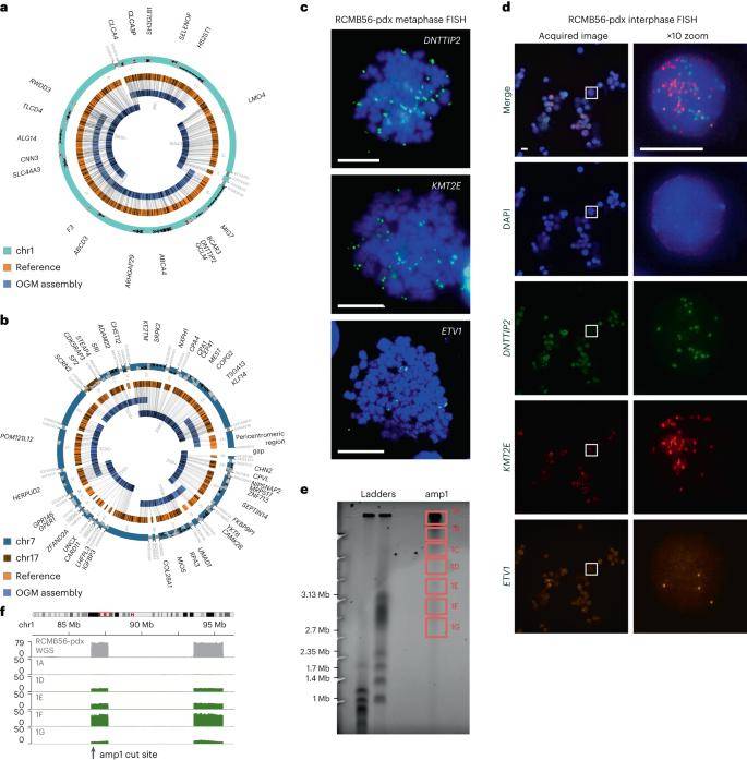 Distinct high-copy extrachromosomal amplifications coexist in a SHH medulloblastoma tumor.