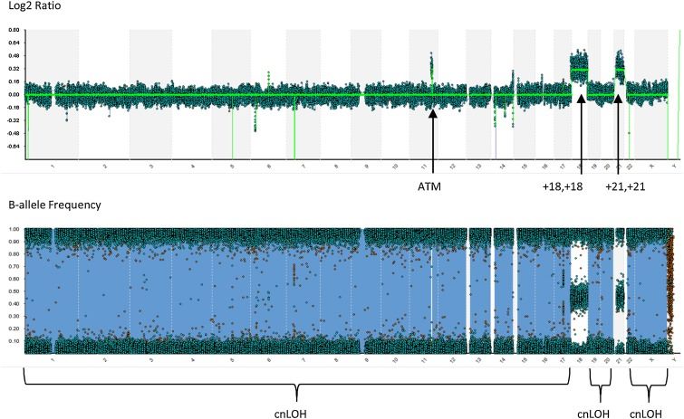 Whole genome view from a SNP-microarray performed on the diagnostic bone marrow specimen submitted for investigation of ALL. (Berry et al., 2019)