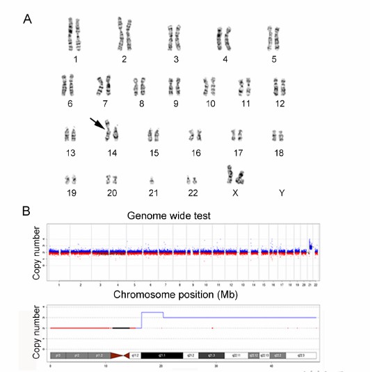 Karyotyping combined with LP-WGS results of case (Zhang et al., 2022)
